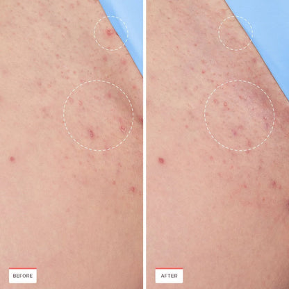 Smoothing Serum – For Ingrown Hairs, Razor Bumps & Burn