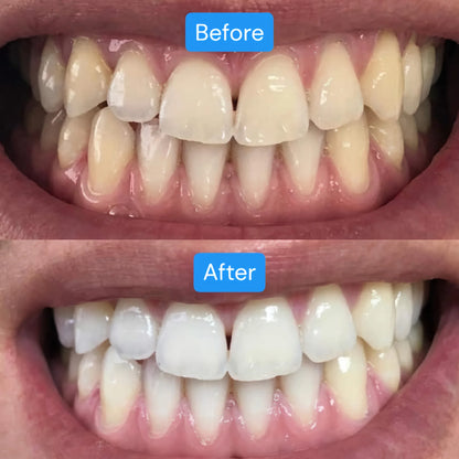 Teeth Whitening Strips (1 Pack- 4 Strips)