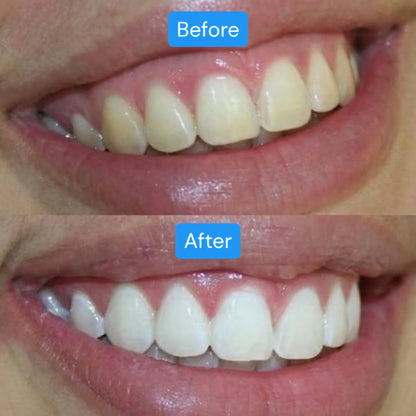 Teeth Whitening Strips (1 Pack- 4 Strips)