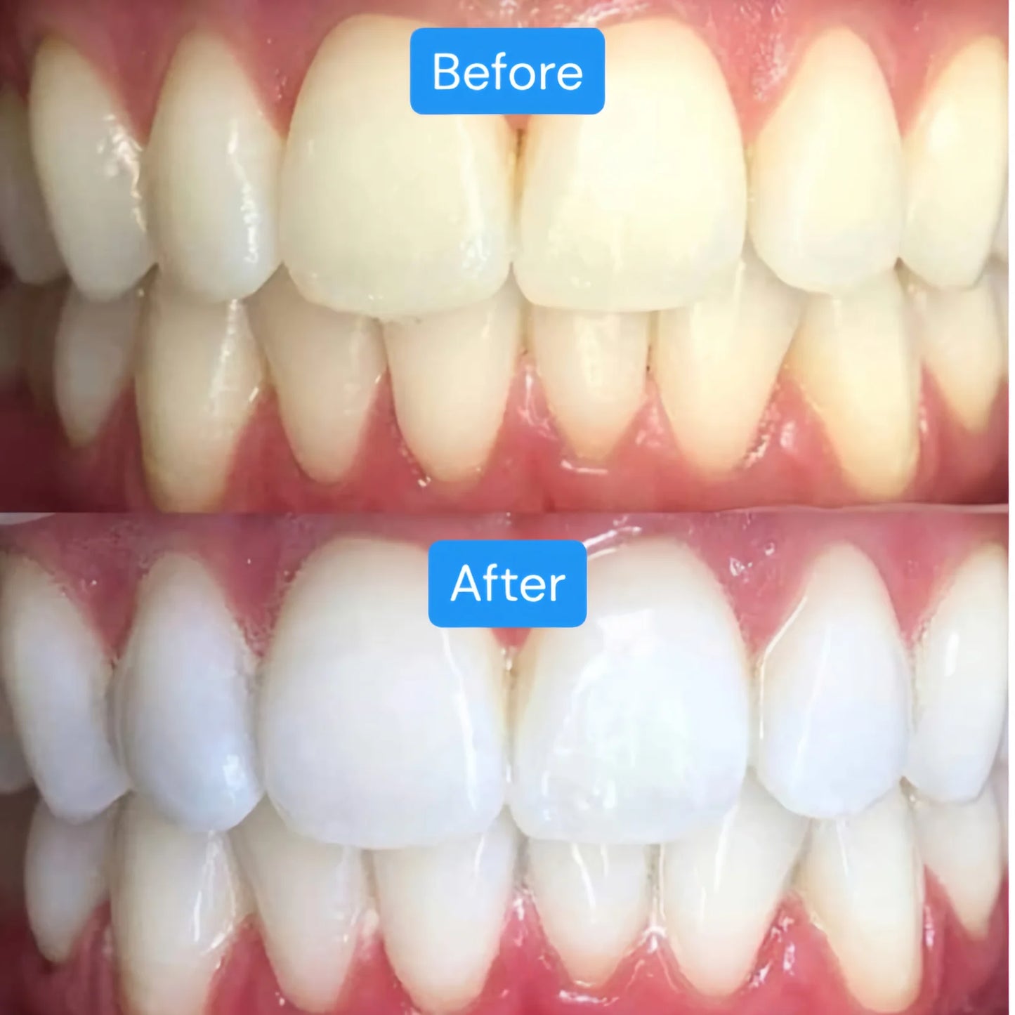 Teeth Whitening Strips (1 Pack- 4 Strips)